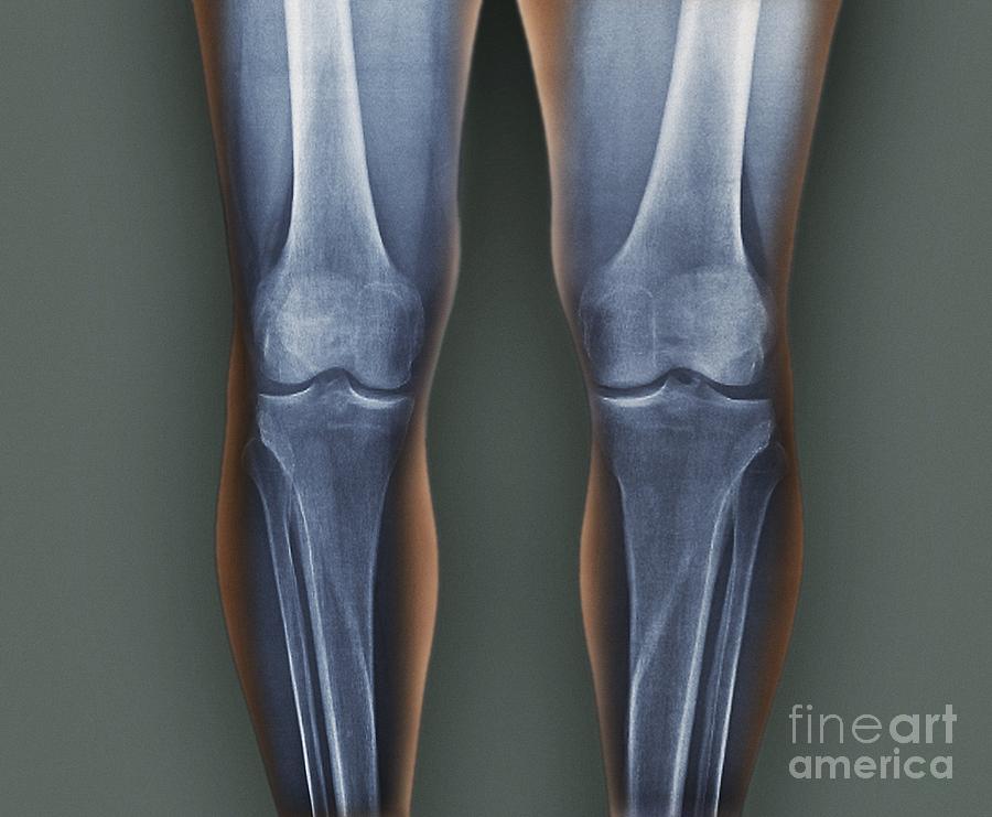 Normal Knees X Rays Photograph By Zephyr Pixels