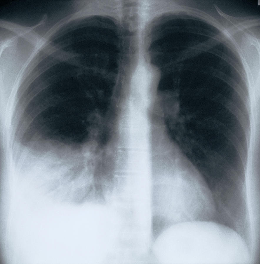 Бактериальная пневмония рентген
