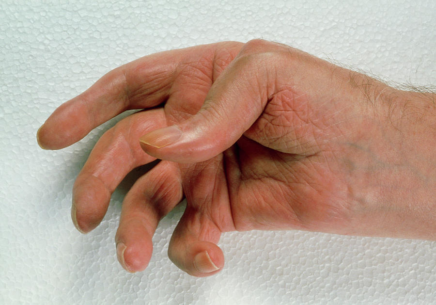 Rheumatoid Arthritis Photograph By Mike Devlin Science Photo Library