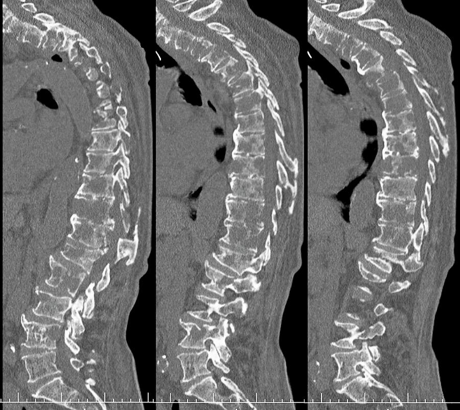 Secondary Spinal Cancer By Zephyr