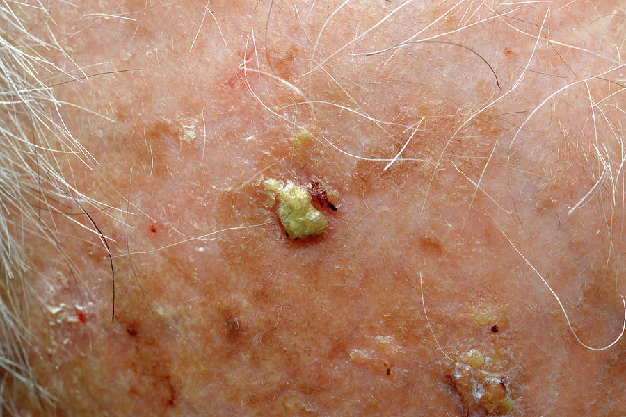 Solar Keratosis Of The Scalp Photograph By Dr P Marazzi Science Photo