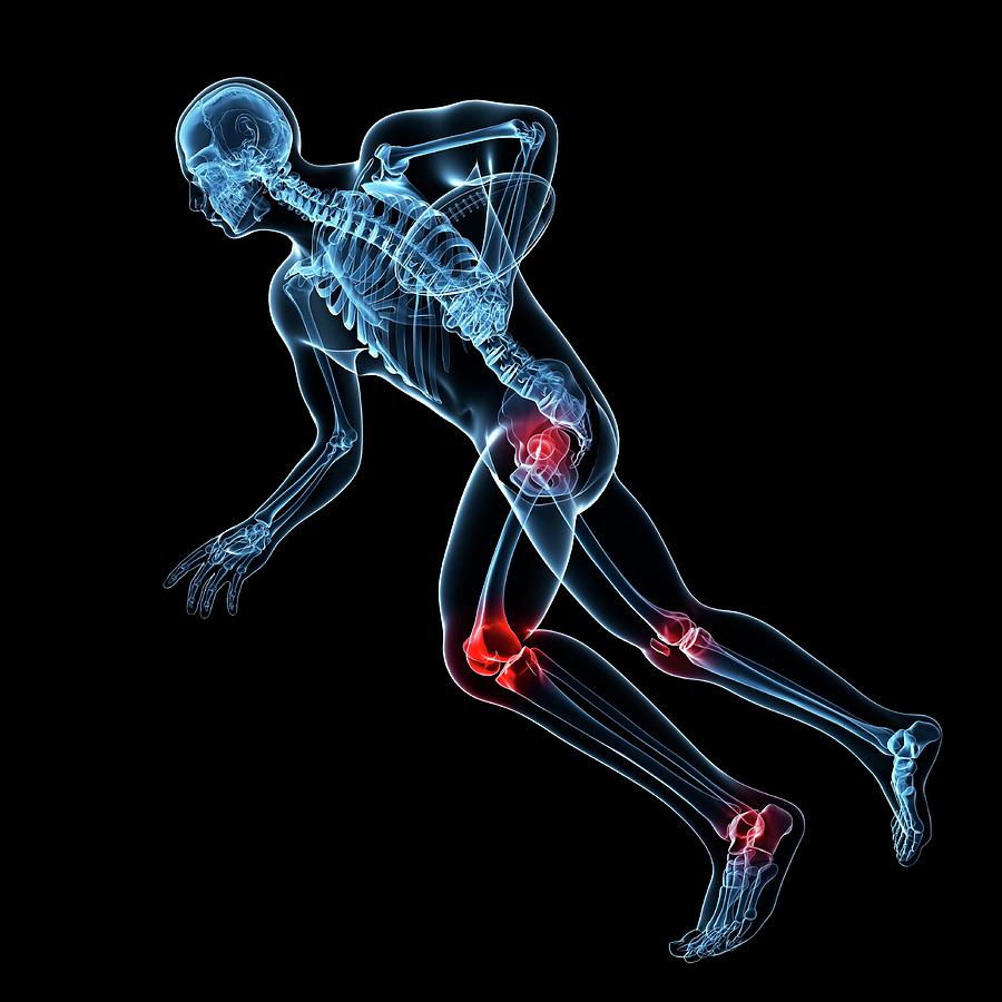 Sports Injuries By Sciepro Science Photo Library