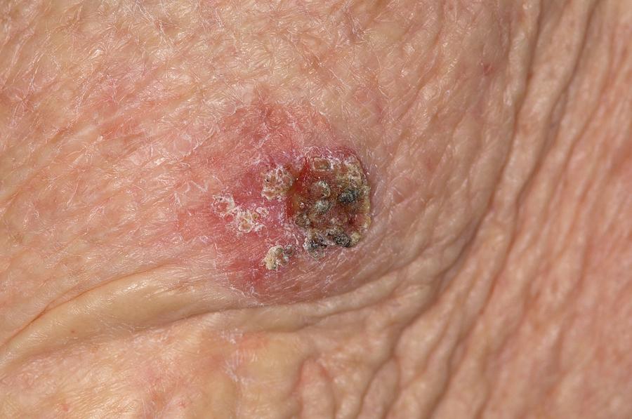 Squamous Cell Cancer On The Arm Photograph By Dr P Marazzi Science