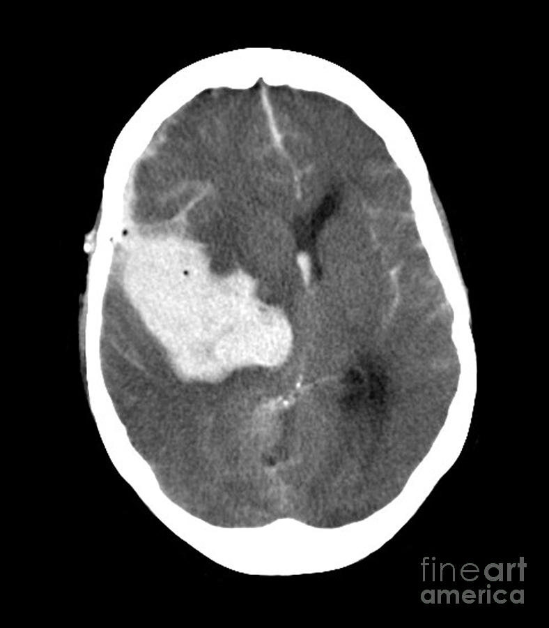 Subarachnoid Hemorrhage Mri Scan Photograph By Du Cane Medical Imaging