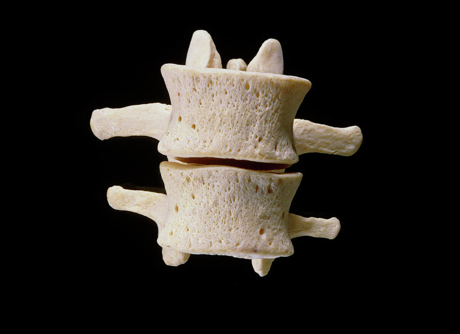 Third And Fourth Lumbar Vertebrae Photograph By James Stevenson Science Photo Library Pixels