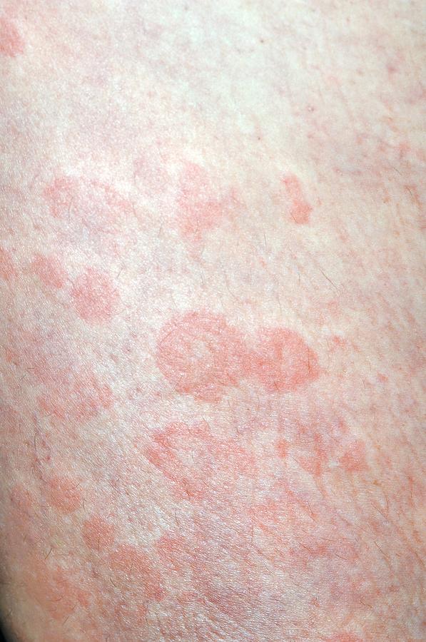 Urticaria Hives On The Leg Photograph By Dr P Marazzi Science Photo