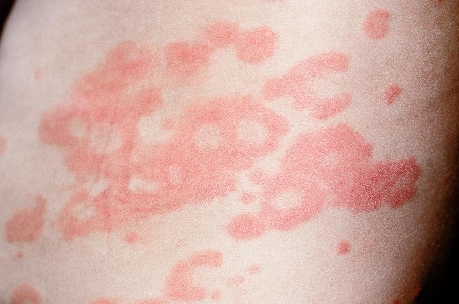 Urticaria Rash On The Skin Photograph By Dr P Marazzi Science Photo