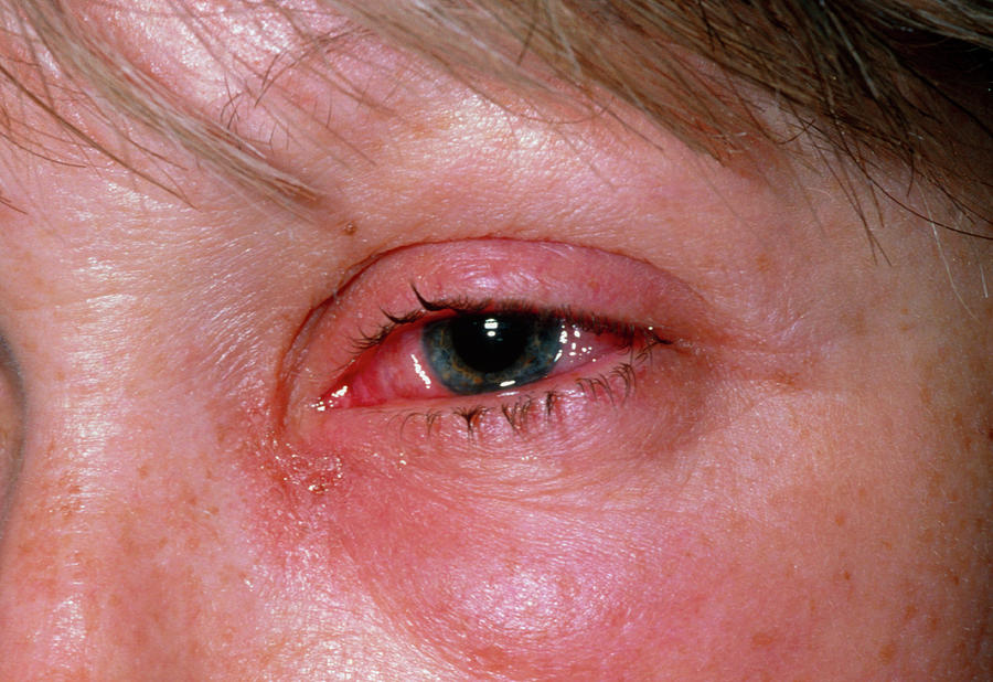 Viral Conjunctivitis In The Eye Of A Woman Photograph By Dr P Marazzi