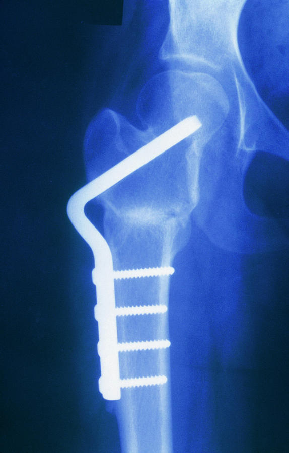 X Ray Of Femoral Osteotomy For Osteoarthritic Hip Photograph By Medical