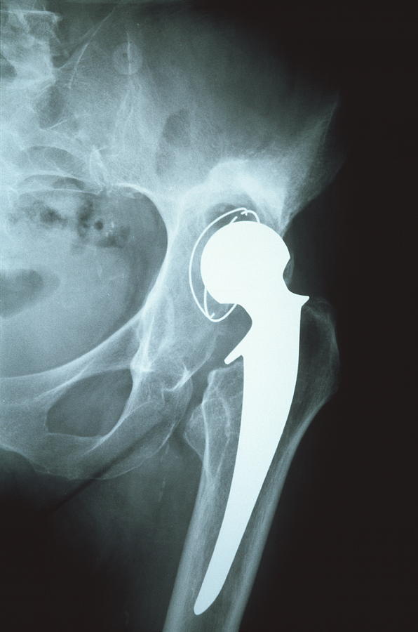 X Ray Showing A Loosened Hip Joint Prosthesis Photograph By Dr P