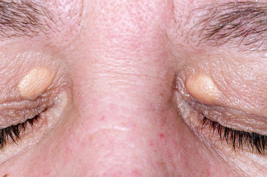 Xanthelasma On The Eyelids Photograph By Dr P Marazzi Science Photo