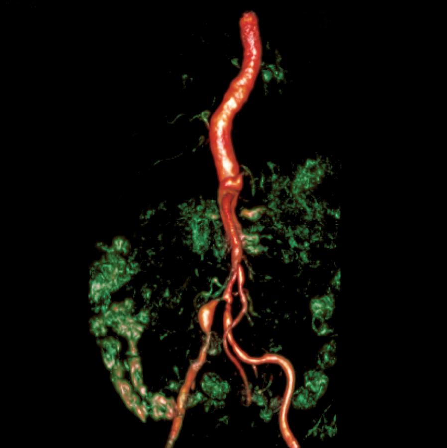 Bilateral Renal Artery Stenosis Mra Sca Photograph By Du Cane Medical