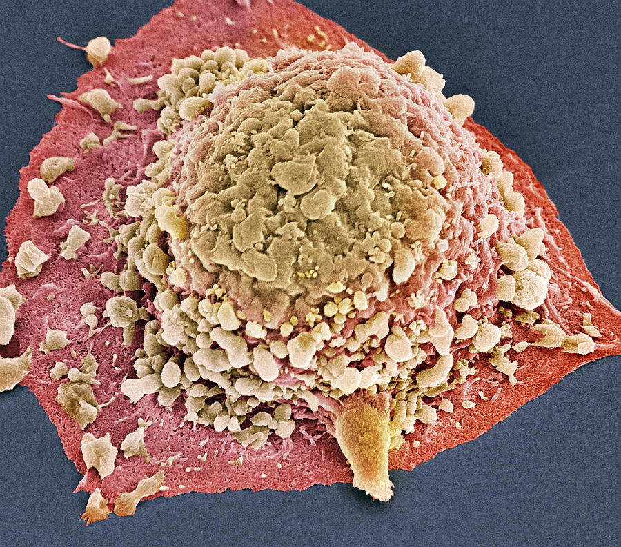 Colon Cancer Cell Sem Photograph By Steve Gschmeissner