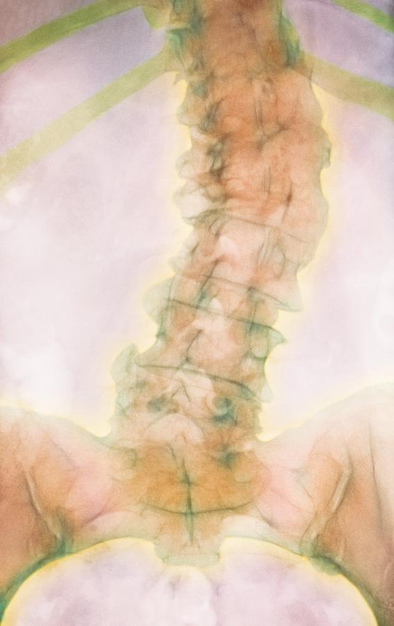 Osteoporosis Of Spine X Ray Photograph By Pixels