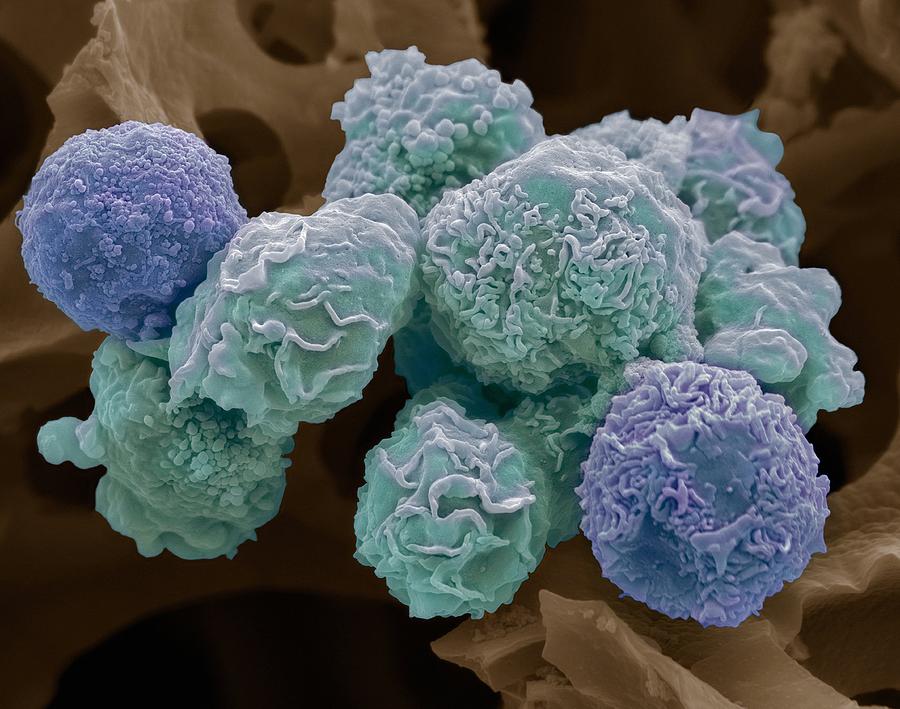 cervical-cancer-cells-sem-photograph-by-steve-gschmeissner