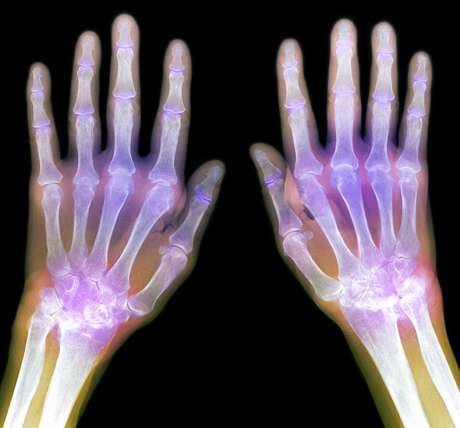 Rheumatoid Arthritis Of The Hands X Ray Photograph By Du Cane Medical Imaging Ltd