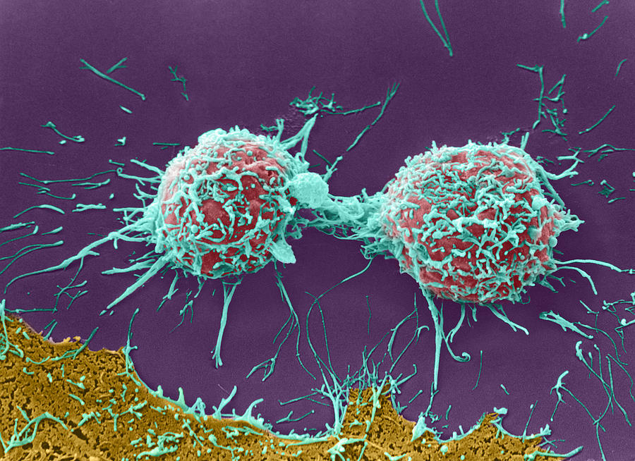 Coloured Sem Of Cervical Cancer Cells Dividing Photograph By Steve