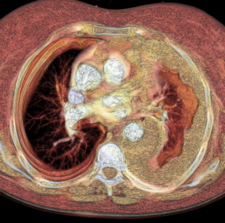 lung-cancer-ct-scan-photograph-by-du-cane-medical-imaging-ltd