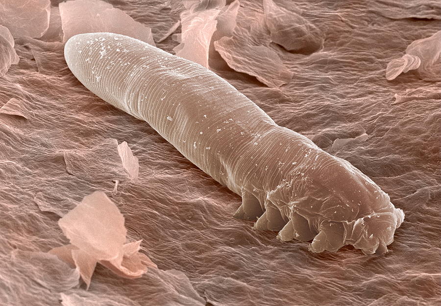 Demodex Are Tiny, White, Parasitic Mites That Inhabit ...