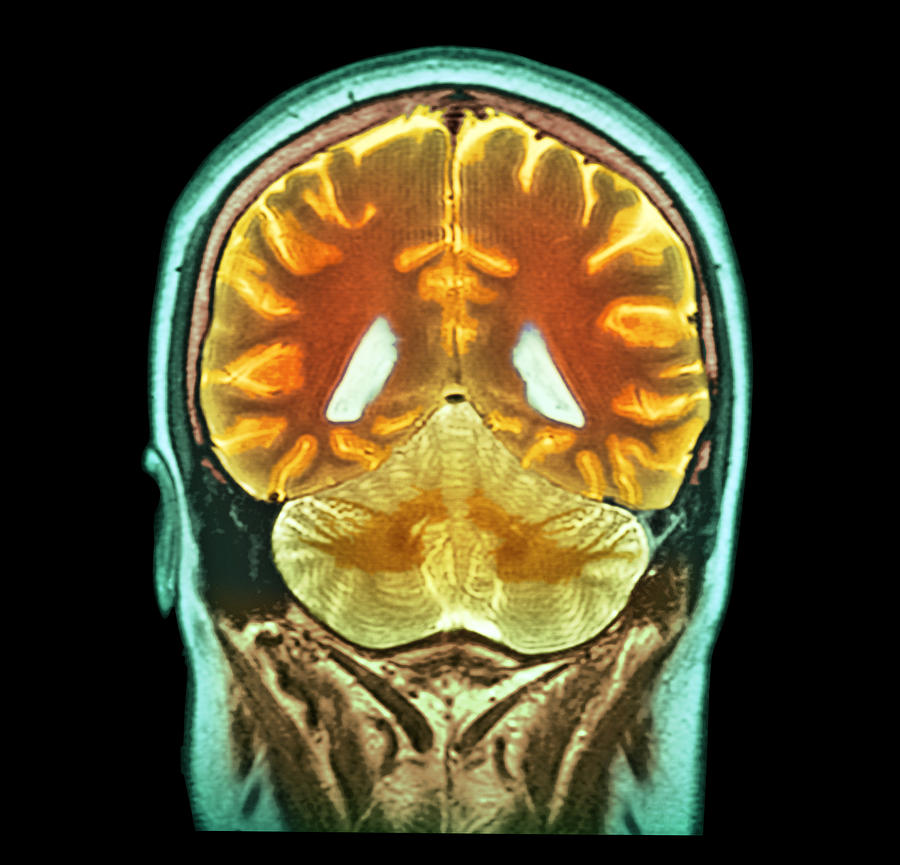 Healthy Human Brain Mri