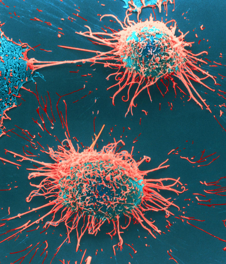 Cervical Cancer Cells Photograph By Steve Gschmeissner Pixels