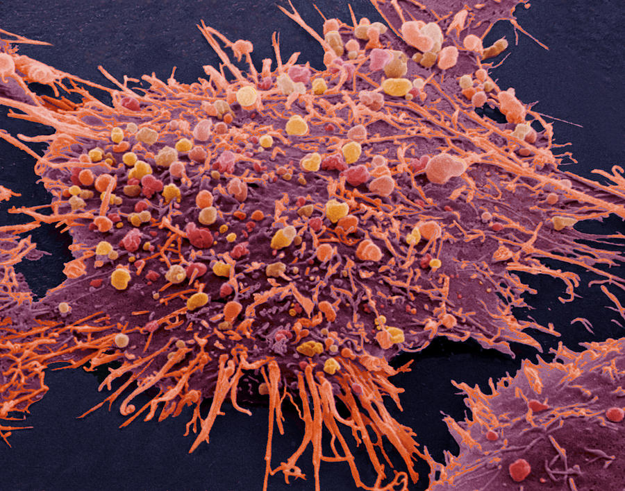 Coloured Sem Of A Breast Cancer Cell Photograph By Steve Gschmeissner