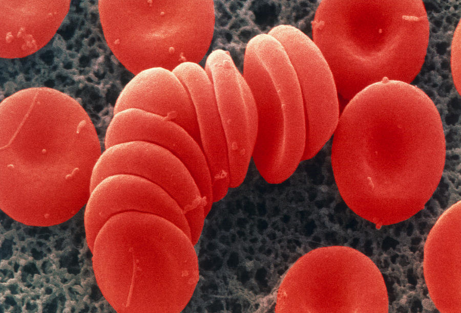 Coloured Sem Of Red Blood Cells, Rouleau Formation Photograph by Power