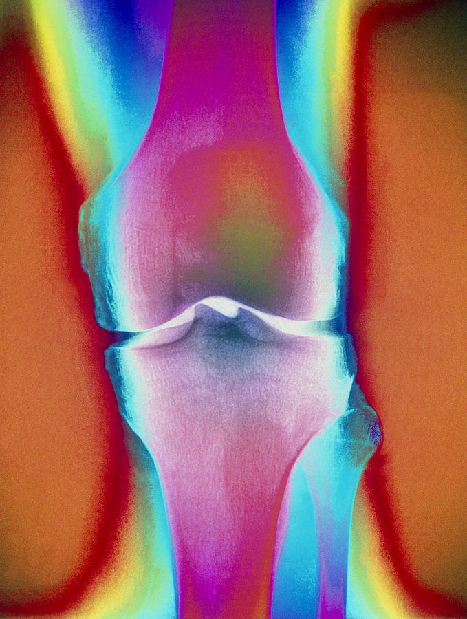 Coloured X Ray Of A Human Knee Joint Photograph By Mehau Kulyk Fine