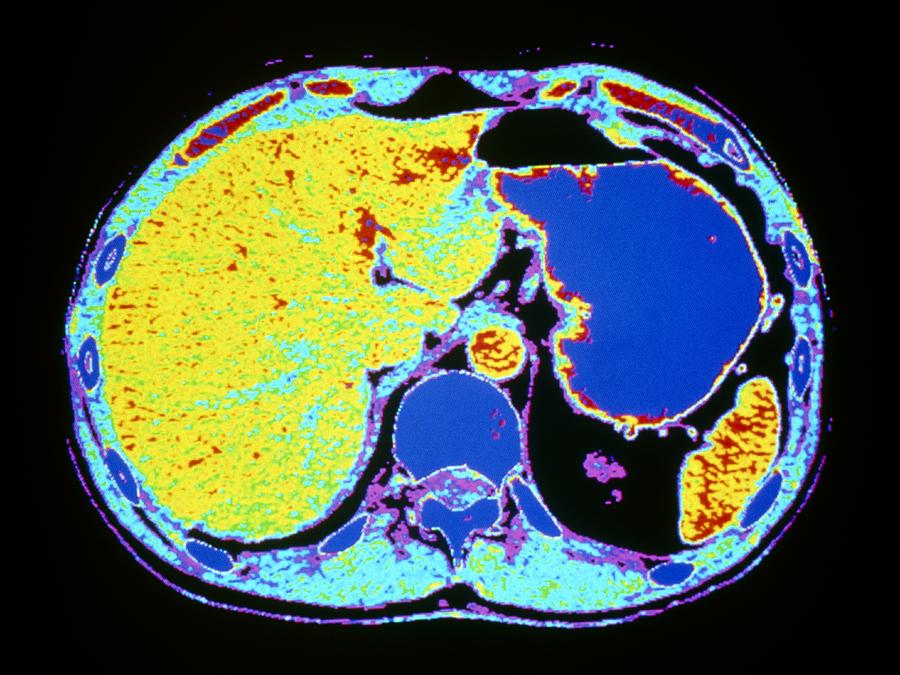 False Colour Ct Scan Of Liver Stomach Photograph By Cnri Fine Art