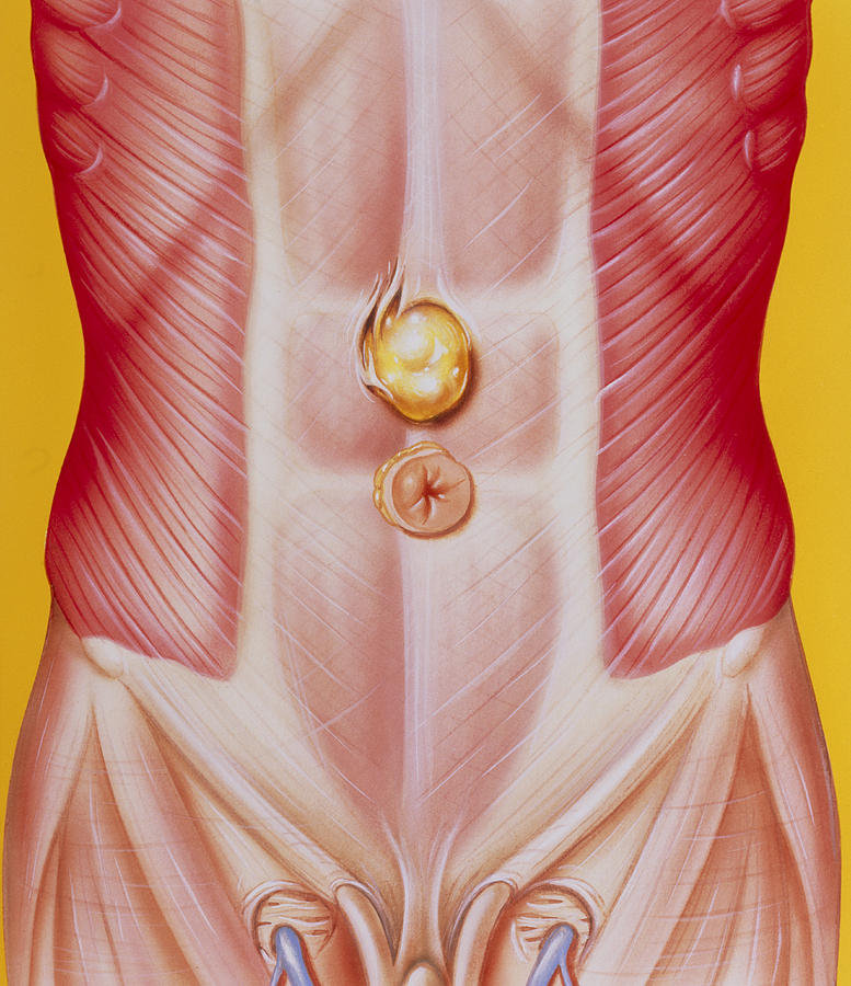 Illustration Of An Epigastric Abdominal Hernia Photograph By John Bavosi