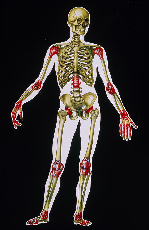 Illustration Of Arthritis Sites On The Body Photograph By John Bavosi