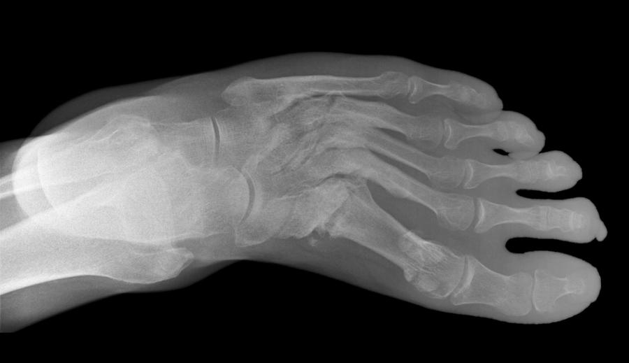 Lisfranc Fracture X Ray Photograph By Du Cane Medical Imaging Ltd