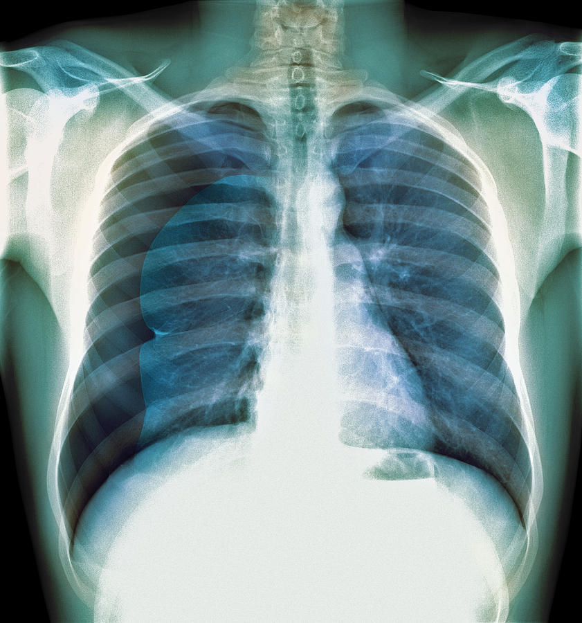 Pneumothorax X Ray Photograph By Du Cane Medical Imaging Ltd Pixels