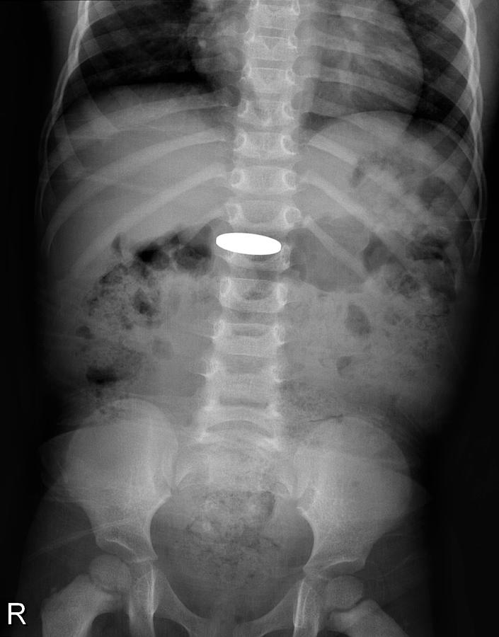 swallowed coin x ray