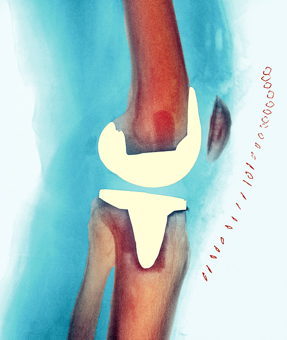 Prothesis knee