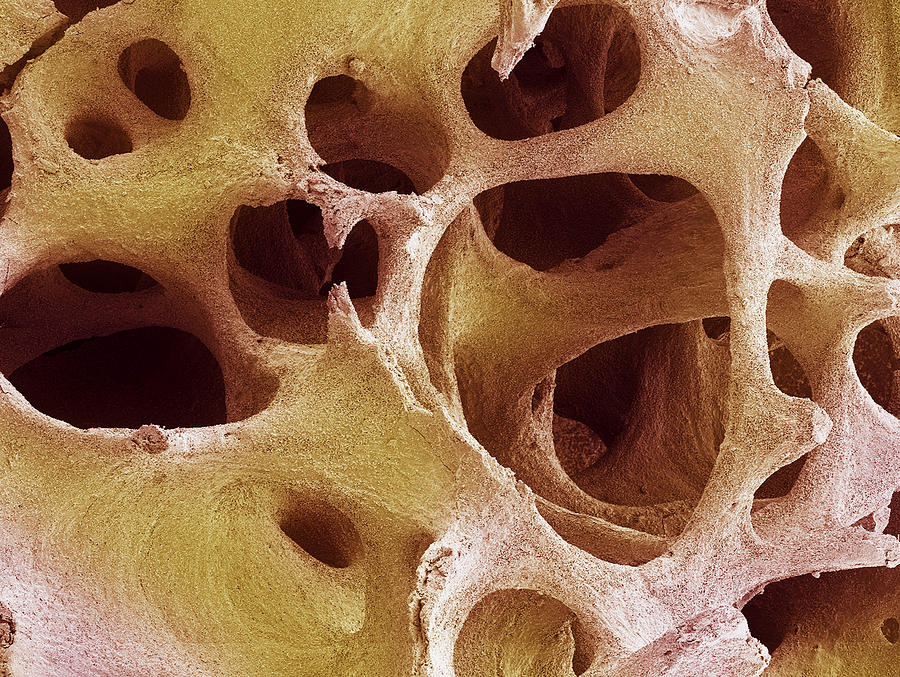 Bone Tissue Sem Photograph By Steve Gschmeissner Fine Art America