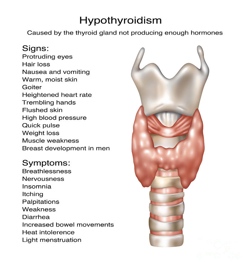 Hypothyroidism Illustration Photograph By Gwen Shockey