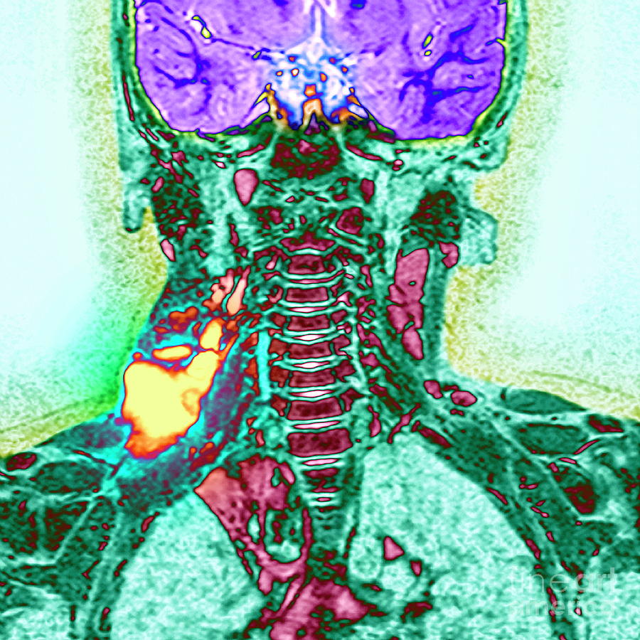 Cystic Growth By Simon Fraser Newcastle Hospitals Nhs Trust Science