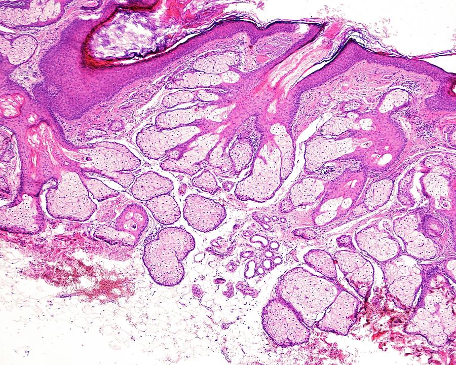 Sebaceous Glands Photograph By Jose Calvo Science Photo Library Pixels