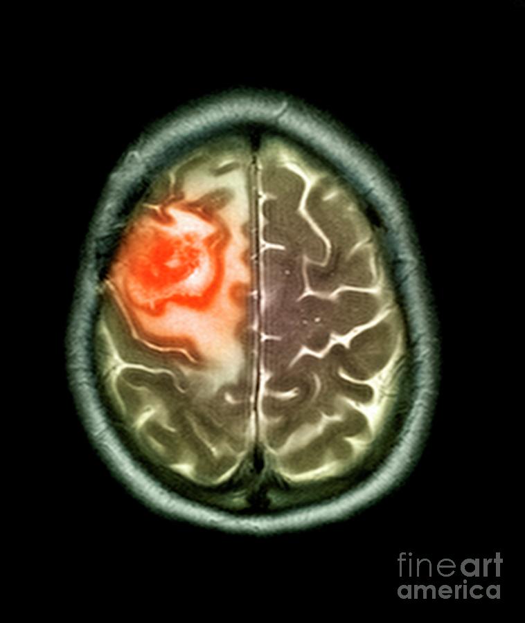 Secondary Brain Cancer By Science Photo Library