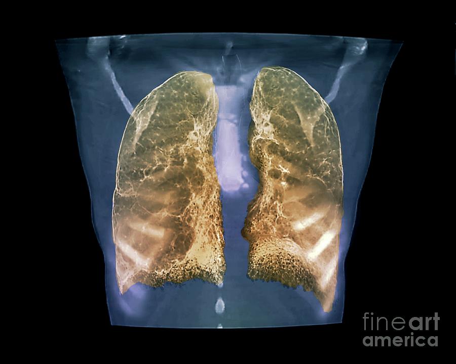 Emphysema 11 By Zephyr Science Photo Library