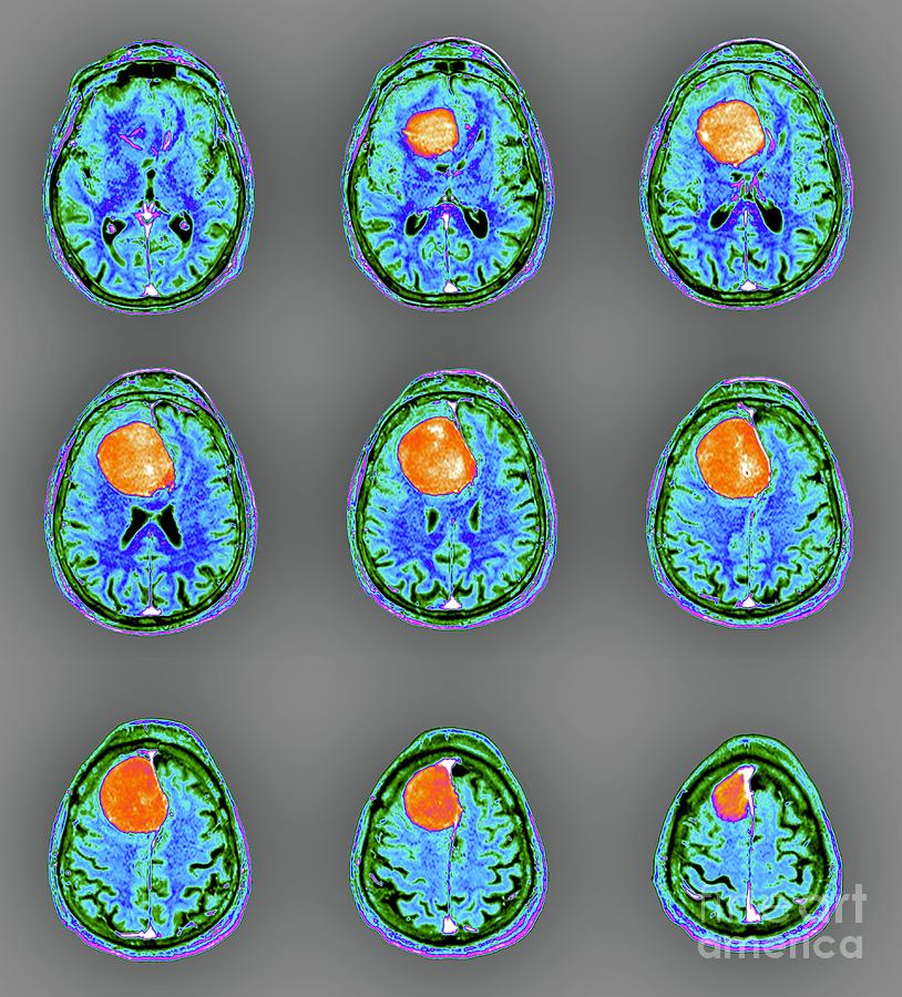 Meningioma Brain Tumour Photograph By Zephyr Science Photo Library