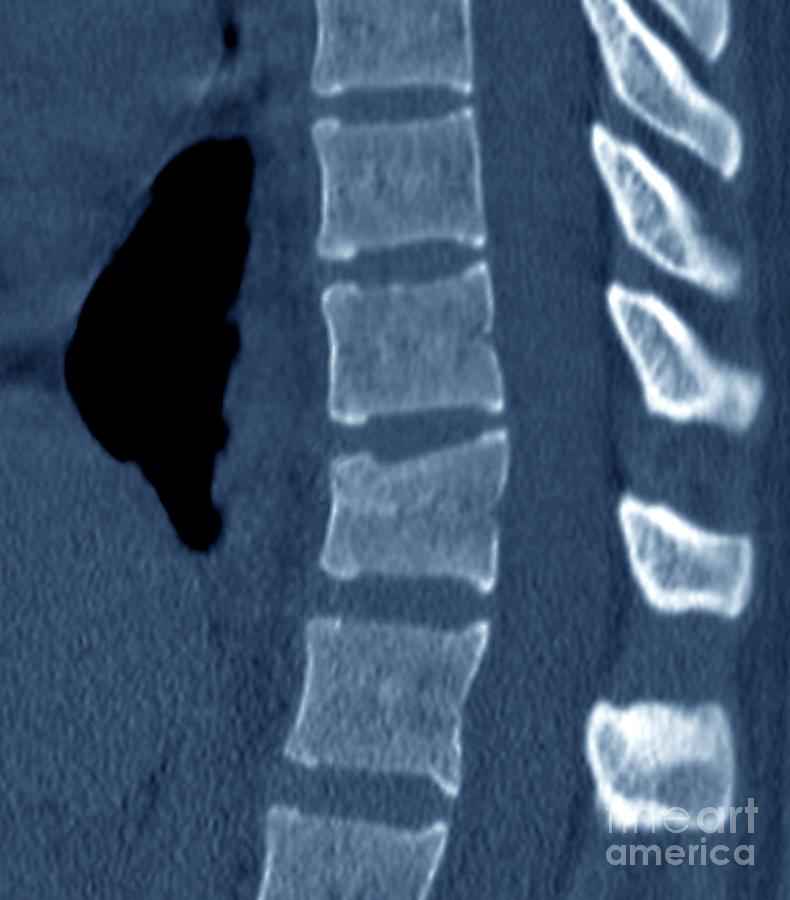 Thoracic Spine Fracture Photograph By Zephyr Science Photo Library Pixels