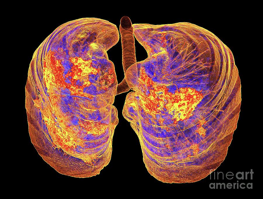 Lungs Affected By Covid 19 Atypical Pneumonia Photograph By K H Fung