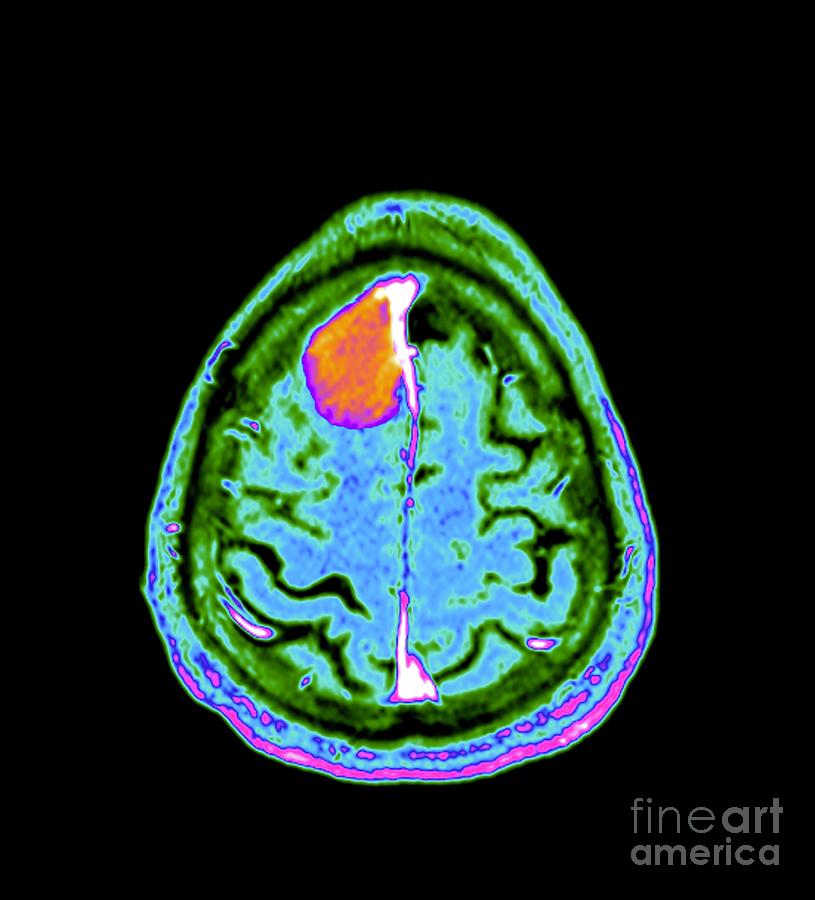 Meningioma Brain Tumour Photograph By Zephyr Science Photo Library