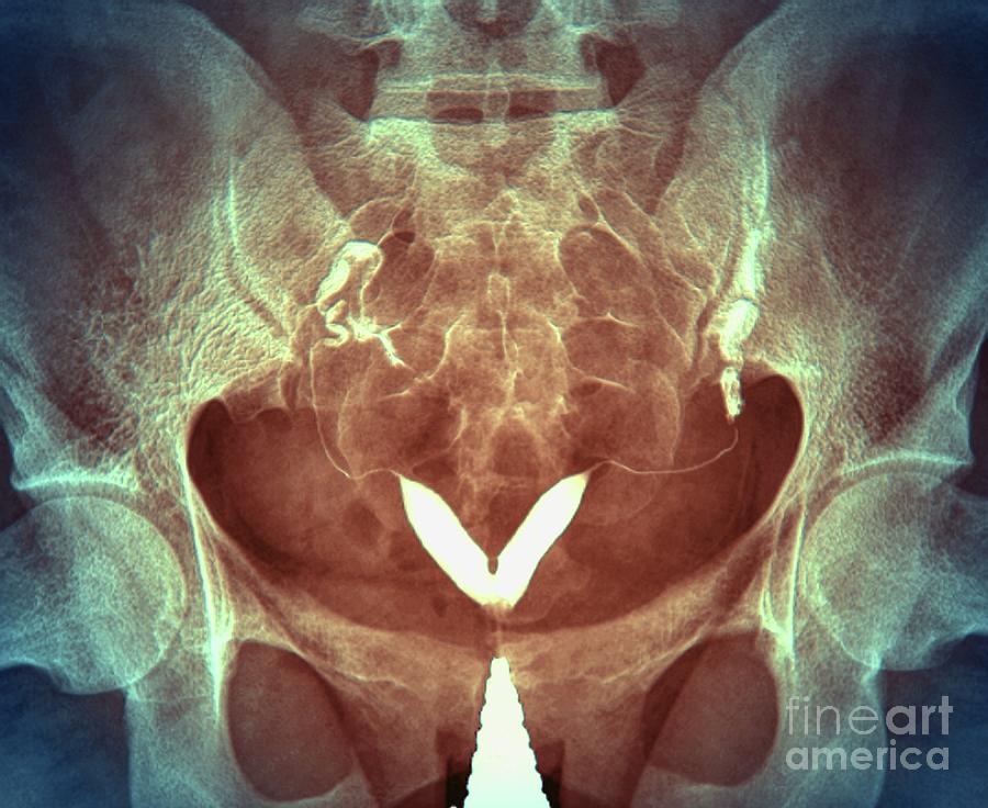 Bicornuate Uterus 2 By Zephyr Science Photo Library