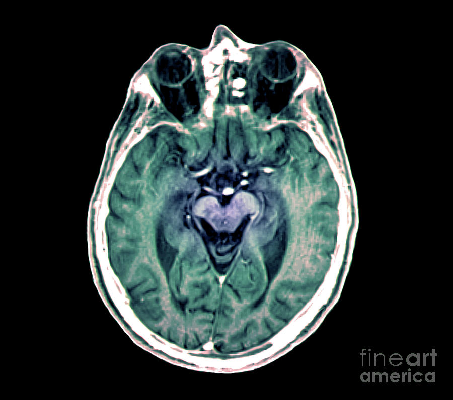 Cerebral Atrophy Photograph By Zephyr Science Photo Library Fine Art