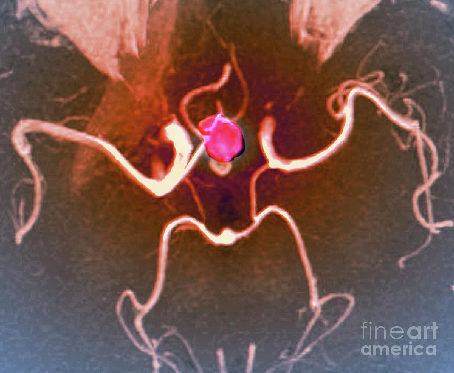 Cerebral Haemorrhage And Aneurysm 2 By Zephyr Science Photo Library