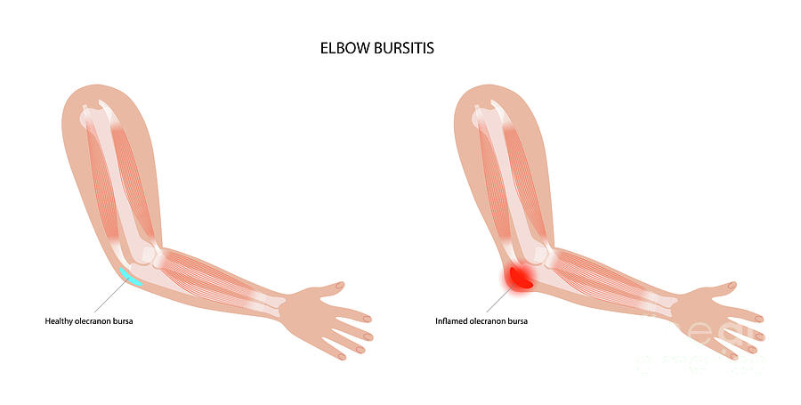 Elbow Bursitis By Pikovit Science Photo Library