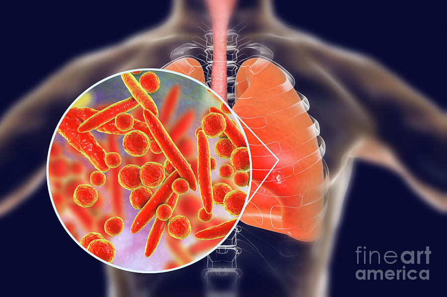 Pneumonia Caused By Mycoplasma Pneumoniae Bacteria Photograph By